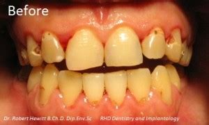 albarillo dental clinic|Sharing one of our oral rehab case patient. We are grateful.